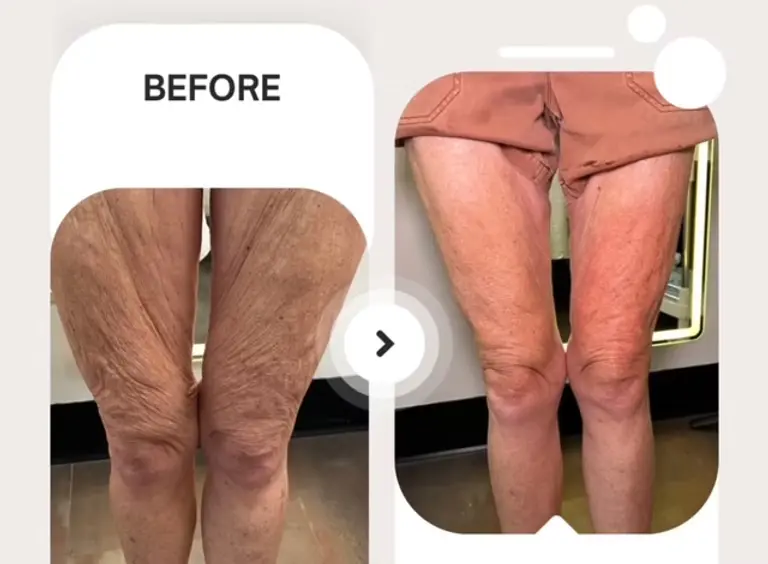 Sky Roller Lymphatic Treatment